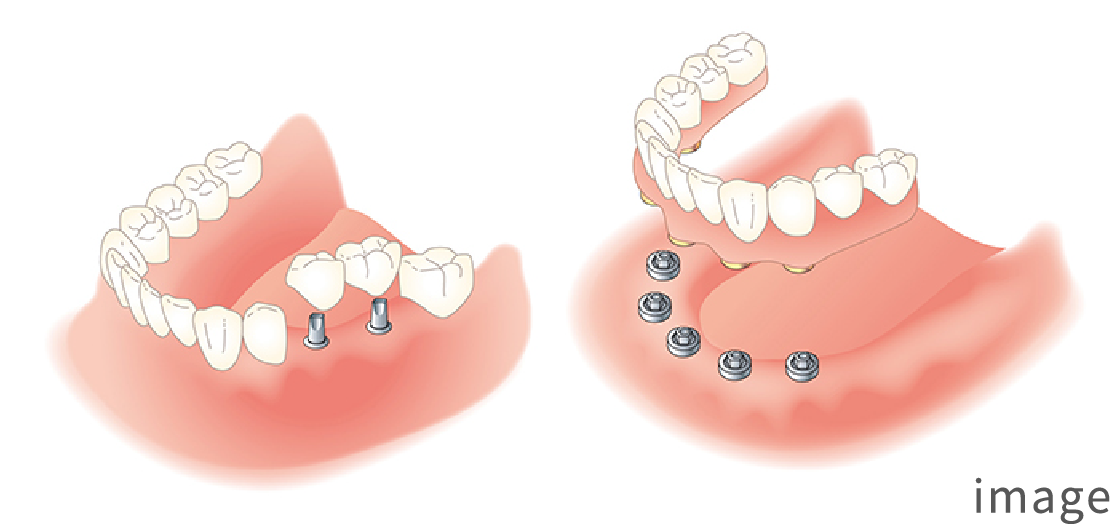 インプラントのイメージ