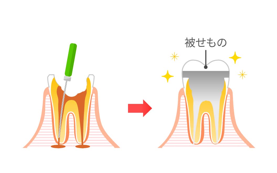 根管治療