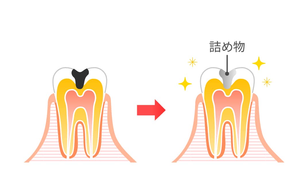 虫歯治療