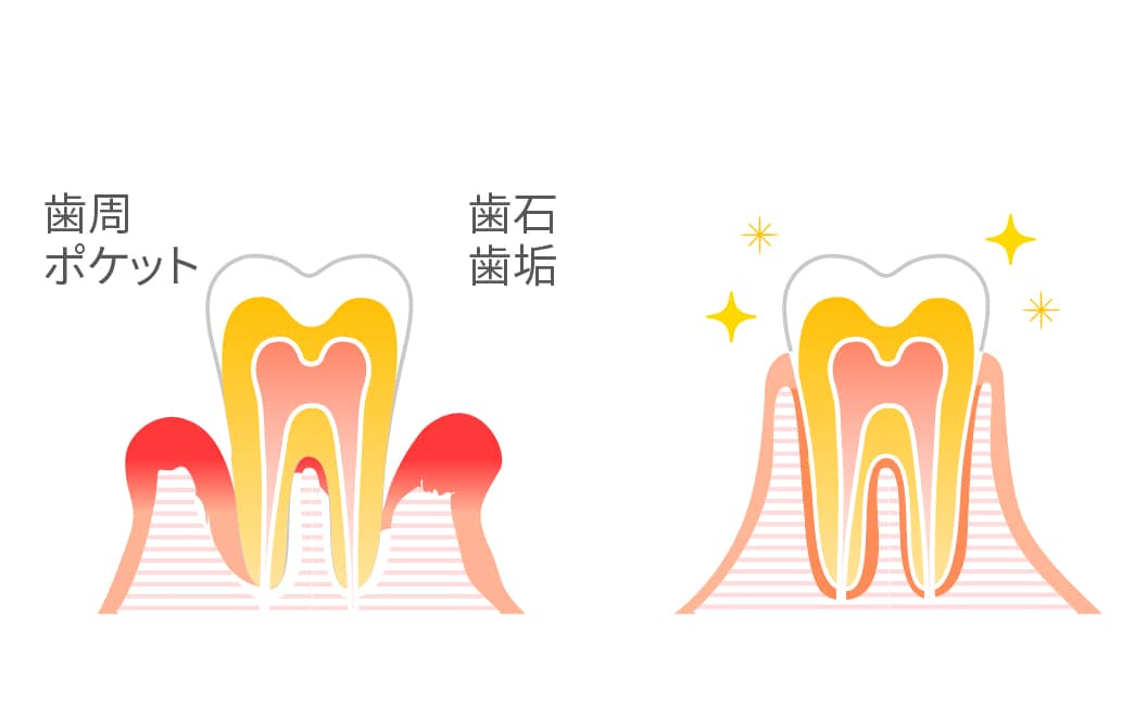 歯周病治療